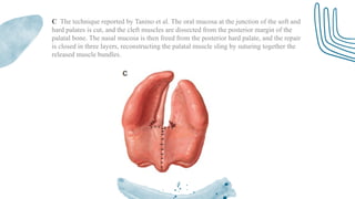 SEMINAR 27 - CLEFT PALATE and it's management.pptx