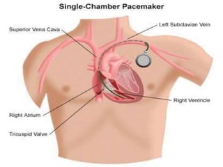 Pacemaker | PPTX