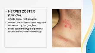 • HERPES ZOSTER
(Shingles)
• infects dorsal root ganglion
• severe pain in dermatomal segment
subserved by the ganglion
• elicits segmental type of pain that
circles halfway around the body
65
 