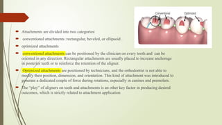 Rectangular Attachment Comprehensive Guide on the Role of Attachments in Clear Aligners for ...