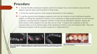 Comprehensive Guide on the Role of Attachments in Clear Aligners for ...