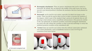 Rectangular Attachment Comprehensive Guide on the Role of Attachments in Clear Aligners for ...