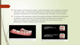 Rectangular Attachment Comprehensive Guide on the Role of Attachments in Clear Aligners for ...