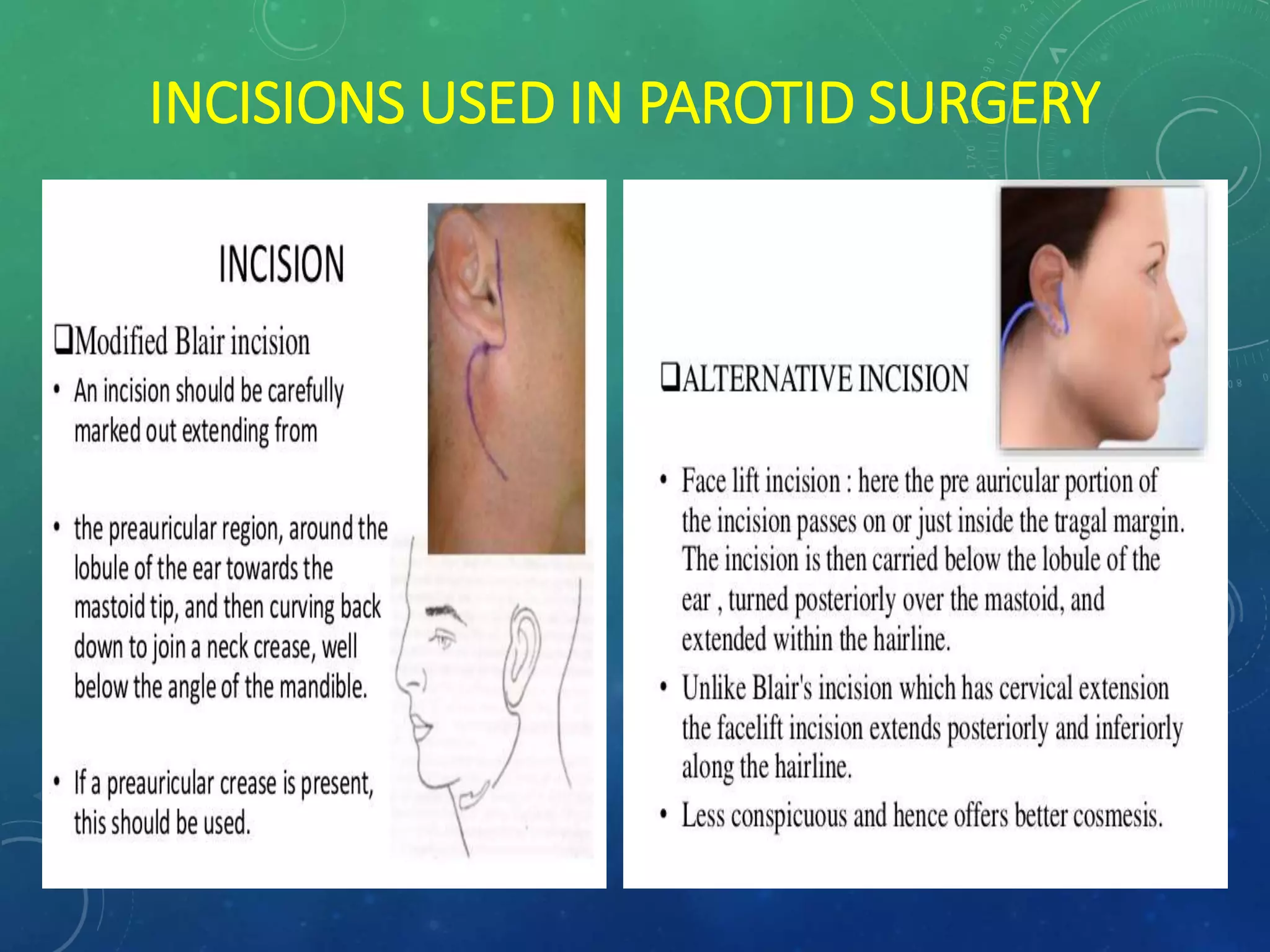 Parotid Incision Types Surgical Anatomy of Salivary Glands and its Applied aspects | PPTX