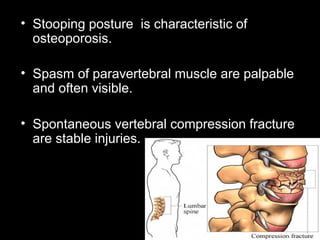 • Stooping posture is characteristic of
osteoporosis.
• Spasm of paravertebral muscle are palpable
and often visible.
• Spontaneous vertebral compression fracture
are stable injuries.
 