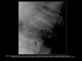 Lateral radiograph of the lumbar spine in a 55-year-old woman with postmenopausal osteoporosis shows generalized osteopenia,
compression fractures, and biconcave vertebral endplates ("fish vertebra"). Notice thin, well-defined vertebral cortices ( arrows).
 