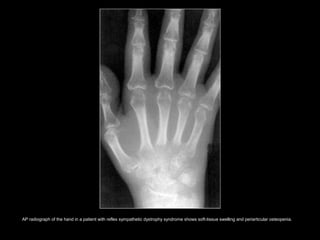 AP radiograph of the hand in a patient with reflex sympathetic dystrophy syndrome shows soft-tissue swelling and periarticular osteopenia.
 
