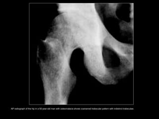AP radiograph of the hip in a 50-year-old man with osteomalacia shows coarsened trabecular pattern with indistinct trabeculae.
 