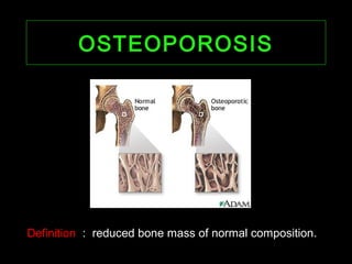 OSTEOPOROSISOSTEOPOROSIS
Definition : reduced bone mass of normal composition.
 