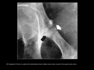 AP radiograph of the hip in a patient with osteomalacia shows multiple Looser zones ( arrows) in the superior pubic ramus.
 