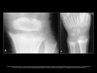 A, AP radiograph of the knee in a 2-year-old girl with rickets shows generalized osteopenia and widening of the metaphyses of the proximal tibia and fibula. B, AP radiograph of
the wrist in another child with rickets shows generalized osteopenia, as well as widening and irregularity of the metaphyses of the distal radius and ulna.
 