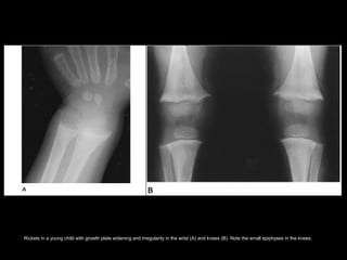 Rickets in a young child with growth plate widening and irregularity in the wrist (A) and knees (B). Note the small epiphyses in the knees.
 
