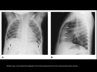 Rachitic rosary. (A) and lateral (B) radiographs of the chest showing prominence of the costochondral junctions (arrows).
 