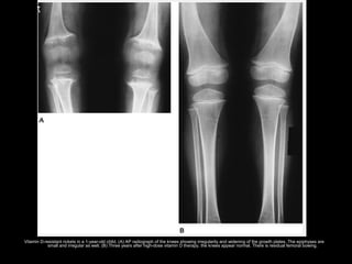 Vitamin D-resistant rickets in a 1-year-old child. (A) AP radiograph of the knees showing irregularity and widening of the growth plates. The epiphyses are
small and irregular as well. (B) Three years after high-dose vitamin D therapy, the knees appear normal. There is residual femoral bowing.
 