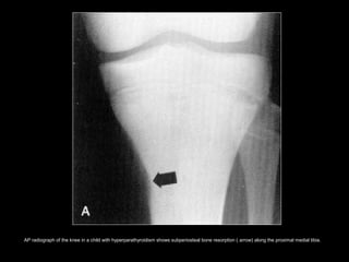 AP radiograph of the knee in a child with hyperparathyroidism shows subperiosteal bone resorption ( arrow) along the proximal medial tibia.
 