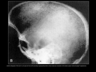 Lateral radiograph of the skull in a 23-year-old man with secondary hyperparathyroidism shows trabecular resorption of the diploic space ("salt and pepper" appearance).
 