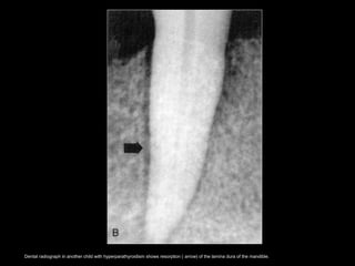 Dental radiograph in another child with hyperparathyroidism shows resorption ( arrow) of the lamina dura of the mandible.
 
