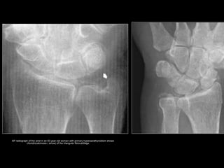 AP radiograph of the wrist in an 83-year-old woman with primary hyperparathyroidism shows
chondrocalcinosis ( arrow) of the triangular fibrocartilage.
 