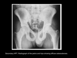 Secondary HPT. Radiograph of the pelvis and hips showing diffuse osteosclerosis.
 