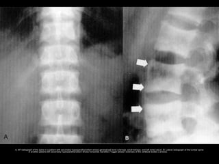 A, AP radiograph of the spine in a patient with secondary hyperparathyroidism shows generalized bone sclerosis, small kidneys, and left renal calculi. B, Lateral radiograph of the lumbar spine
in another patient with secondary hyperparathyroidism shows horizontal, bandlike ("rugger jersey") sclerosis of the vertebral bodies ( arrows).
 