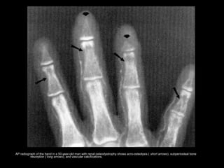 AP radiograph of the hand in a 50-year-old man with renal osteodystrophy shows acro-osteolysis ( short arrows), subperiosteal bone
resorption ( long arrows), and vascular calcifications.
 