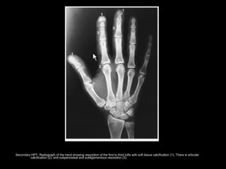 Secondary HPT. Radiograph of the hand showing resorption of the first to third tufts with soft tissue calcification (1). There is articular
calcification (2), and subperiosteal and subligamentous resorption (3).
 