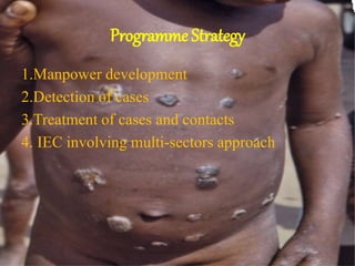 Programme Strategy
1.Manpower development
2.Detection of cases
3.Treatment of cases and contacts
4. IEC involving multi-sectors approach
 