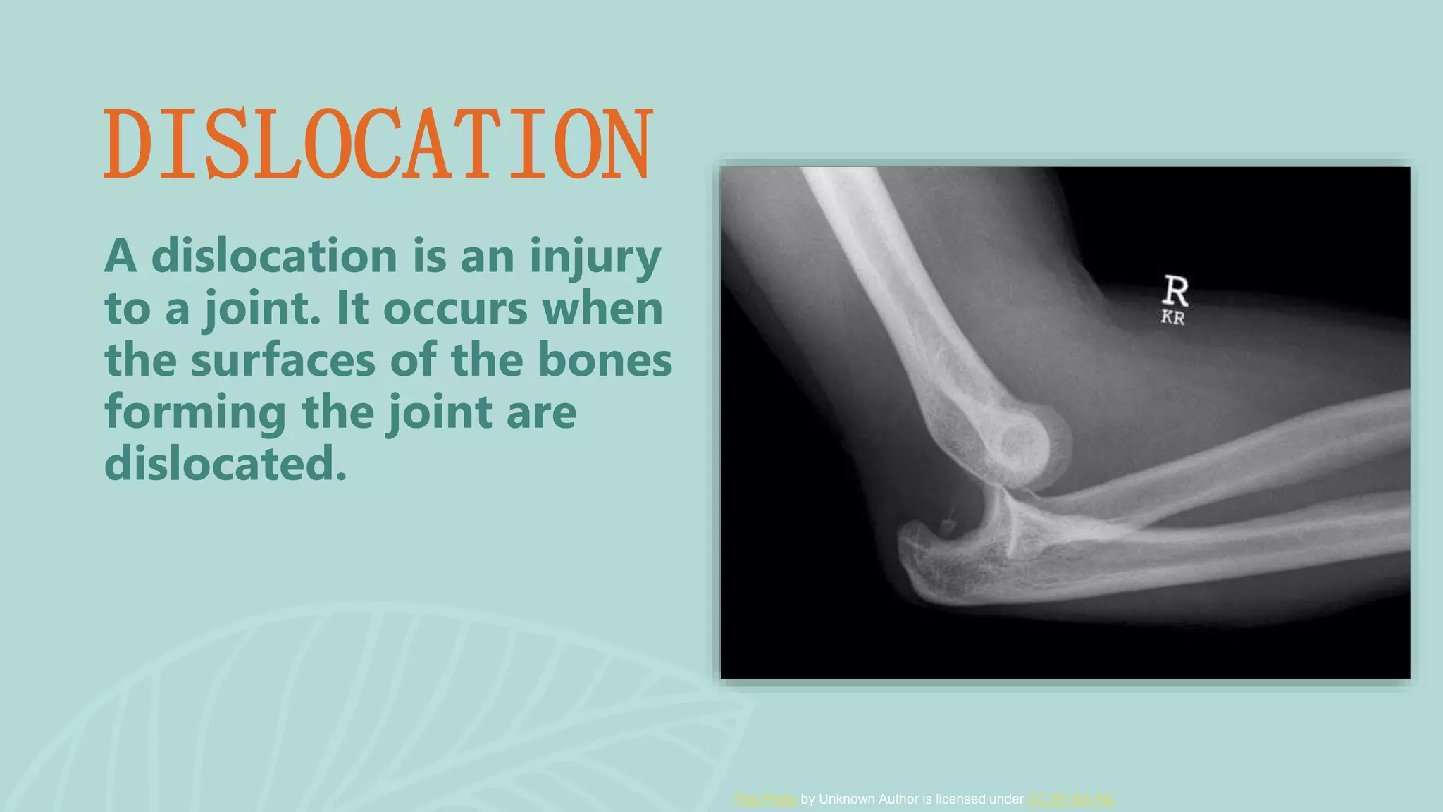 Dislocation,sprain,strain and contusion.pptx