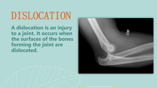 A dislocation is an injury
to a joint. It occurs when
the surfaces of the bones
forming the joint are
dislocated.
DISLOCATION
This Photo by Unknown Author is licensed under CC BY-SA-NC
 