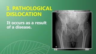 It occurs as a result
of a disease.
3. PATHOLOGICAL
DISLOCATION
 