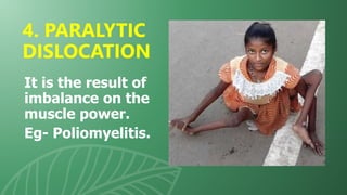 It is the result of
imbalance on the
muscle power.
Eg- Poliomyelitis.
4. PARALYTIC
DISLOCATION
 