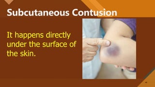 Subcutaneous Contusion
46
It happens directly
under the surface of
the skin.
 