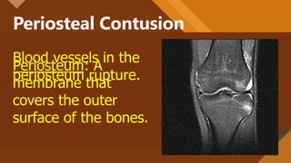 Periosteal Contusion
48
Periosteum: A
membrane that
covers the outer
surface of the bones.
Blood vessels in the
periosteum rupture.
 