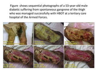 Figure shows sequential photographs of a 53-year-old male
diabetic suffering from spontaneous gangrene of the thigh
who was managed successfully with HBOT at a tertiary care
hospital of the Armed Forces.
 