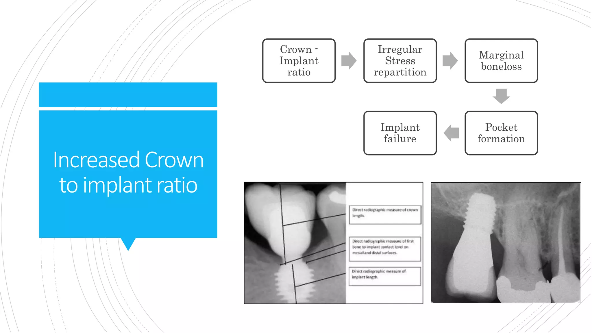 IncreasedCrown
to implantratio
Crown -
Implant
ratio
Irregular
Stress
repartition
Marginal
boneloss
Pocket
formation
Implant
failure
 