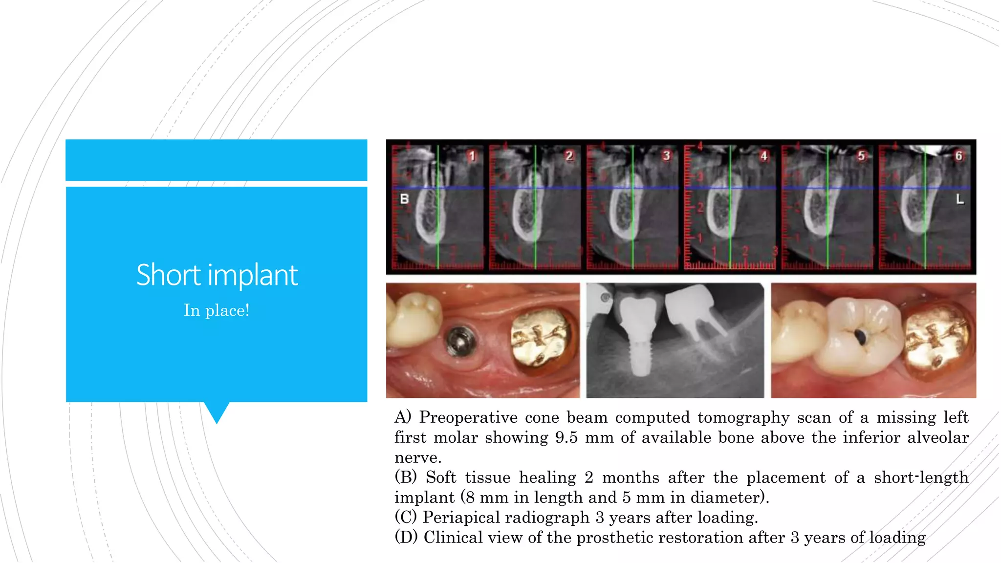 Shortimplant
In place!
A) Preoperative cone beam computed tomography scan of a missing left
first molar showing 9.5 mm of available bone above the inferior alveolar
nerve.
(B) Soft tissue healing 2 months after the placement of a short-length
implant (8 mm in length and 5 mm in diameter).
(C) Periapical radiograph 3 years after loading.
(D) Clinical view of the prosthetic restoration after 3 years of loading
 