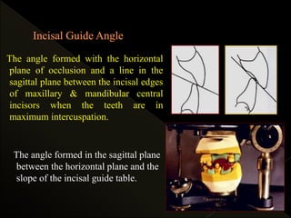 The angle formed with the horizontal
plane of occlusion and a line in the
sagittal plane between the incisal edges
of maxillary & mandibular central
incisors when the teeth are in
maximum intercuspation.
The angle formed in the sagittal plane
between the horizontal plane and the
slope of the incisal guide table.
 