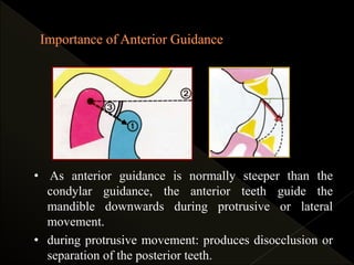 • As anterior guidance is normally steeper than the
condylar guidance, the anterior teeth guide the
mandible downwards during protrusive or lateral
movement.
• during protrusive movement: produces disocclusion or
separation of the posterior teeth.
 