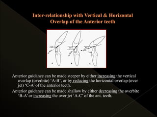Anterior guidance can be made steeper by either increasing the vertical
overlap (overbite) ‘A-B’, or by reducing the horizontal overlap (over
jet) ‘C-A’ of the anterior teeth.
Anterior guidance can be made shallow by either decreasing the overbite
‘B-A’ or increasing the over jet ‘A-C’ of the ant. teeth.
 
