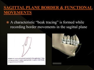  A characteristic “beak tracing” is formed while
recording border movements in the sagittal plane
 