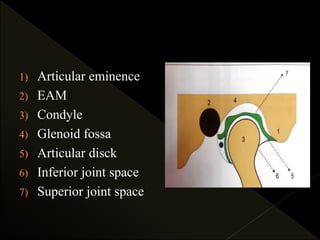 1) Articular eminence
2) EAM
3) Condyle
4) Glenoid fossa
5) Articular disck
6) Inferior joint space
7) Superior joint space
 