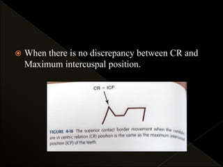  When there is no discrepancy between CR and
Maximum intercuspal position.
 
