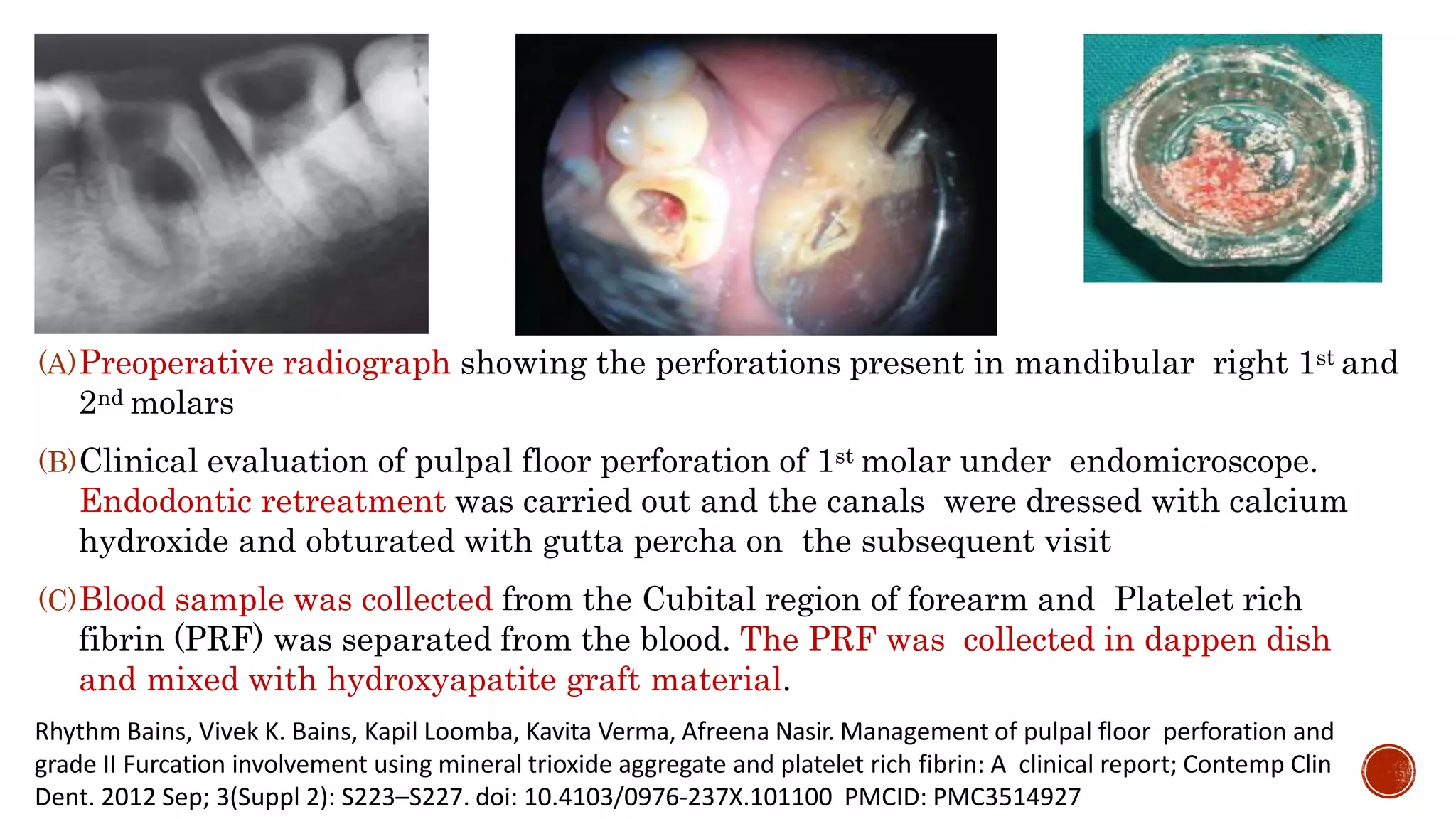 (A)Preoperative radiograph showing the perforations present in mandibular right 1st and
2nd molars
(B)Clinical evaluation of pulpal floor perforation of 1st molar under endomicroscope.
Endodontic retreatment was carried out and the canals were dressed with calcium
hydroxide and obturated with gutta percha on the subsequent visit
(C)Blood sample was collected from the Cubital region of forearm and Platelet rich
fibrin (PRF) was separated from the blood. The PRF was collected in dappen dish
and mixed with hydroxyapatite graft material.
Rhythm Bains, Vivek K. Bains, Kapil Loomba, Kavita Verma, Afreena Nasir. Management of pulpal floor perforation and
grade II Furcation involvement using mineral trioxide aggregate and platelet rich fibrin: A clinical report; Contemp Clin
Dent. 2012 Sep; 3(Suppl 2): S223–S227. doi: 10.4103/0976-237X.101100 PMCID: PMC3514927
 