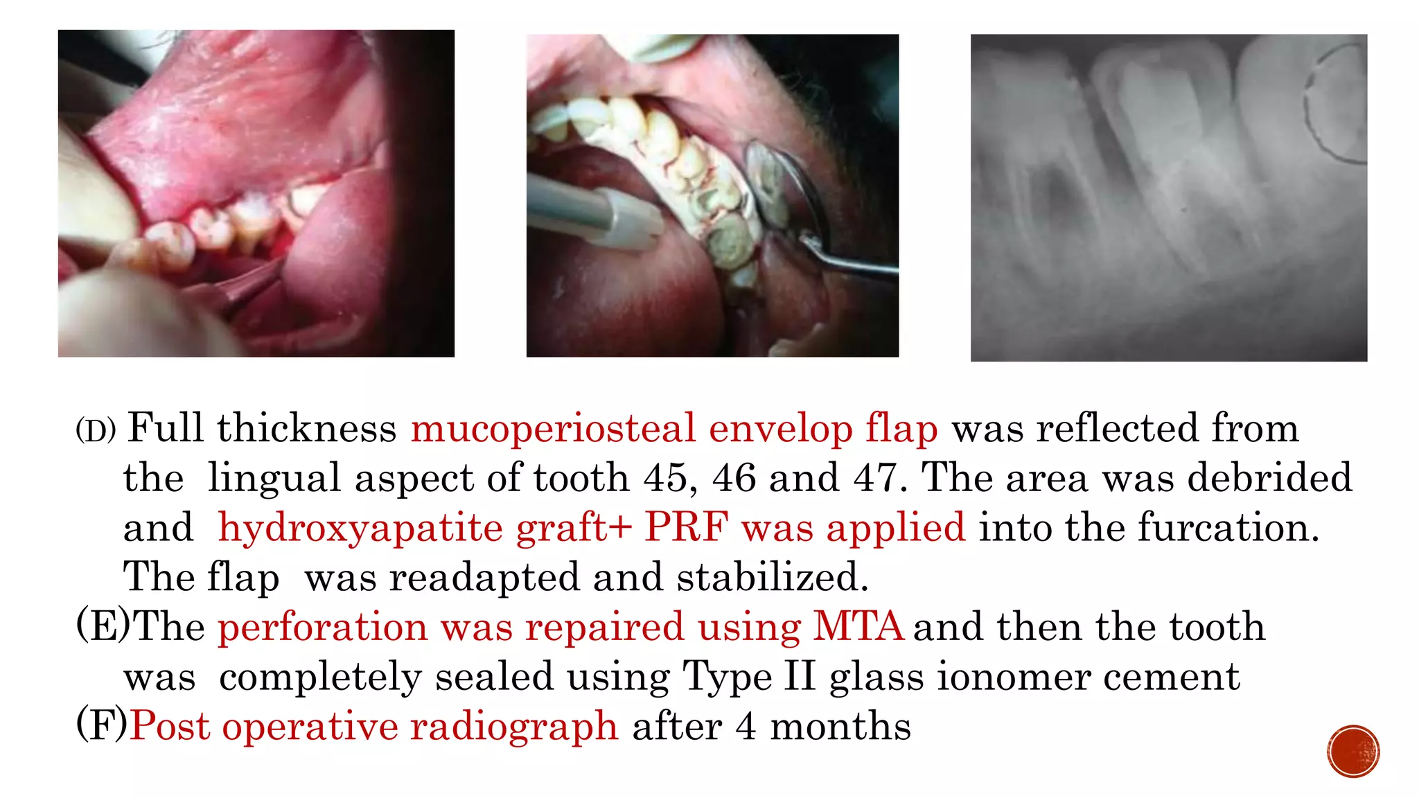 (D) Full thickness mucoperiosteal envelop flap was reflected from
the lingual aspect of tooth 45, 46 and 47. The area was debrided
and hydroxyapatite graft+ PRF was applied into the furcation.
The flap was readapted and stabilized.
(E)The perforation was repaired using MTA and then the tooth
was completely sealed using Type II glass ionomer cement
(F)Post operative radiograph after 4 months
 