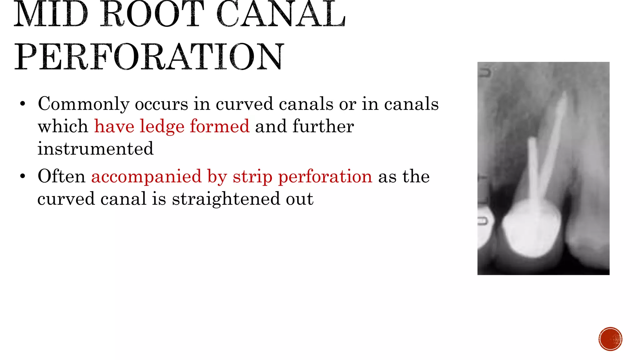 • Commonly occurs in curved canals or in canals
which have ledge formed and further
instrumented
• Often accompanied by strip perforation as the
curved canal is straightened out
 