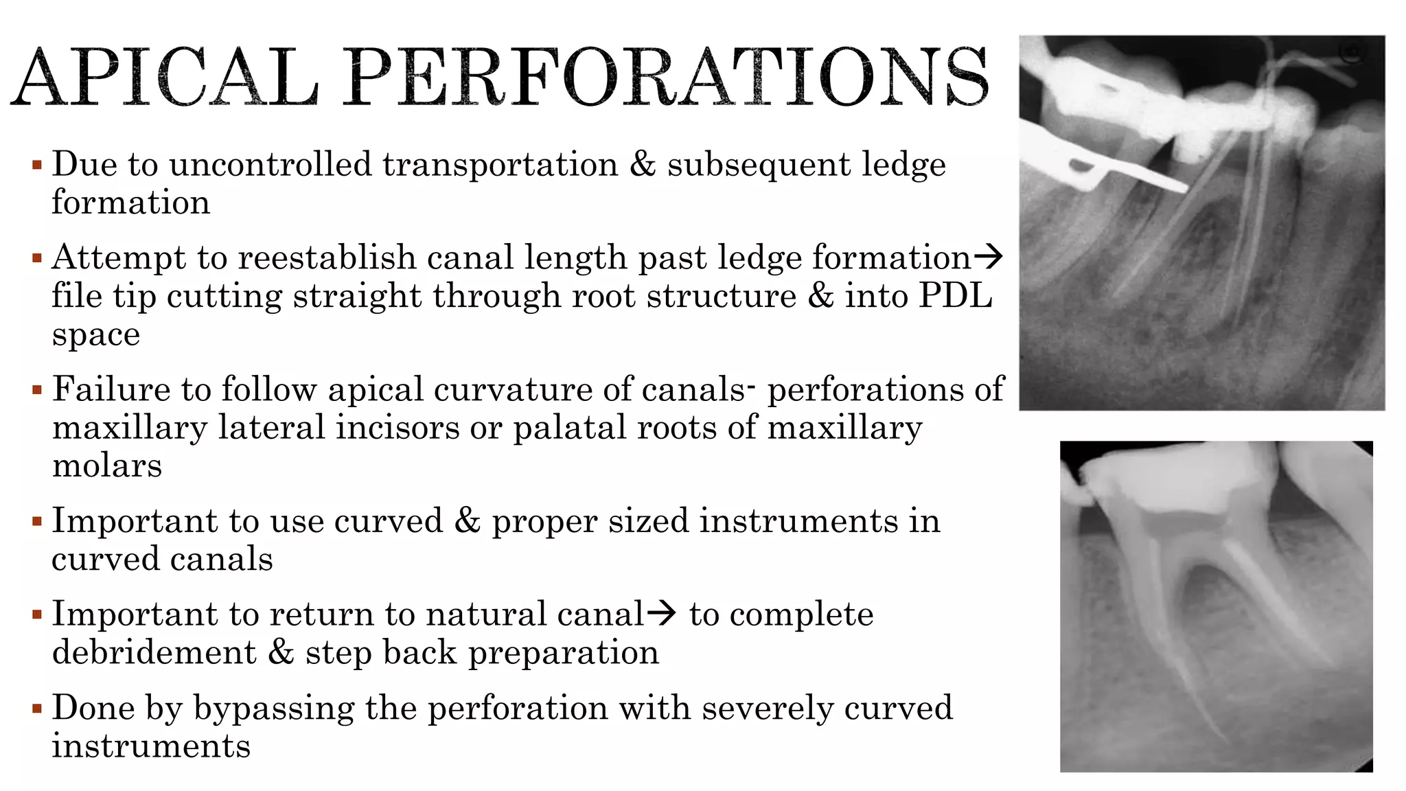  Due to uncontrolled transportation & subsequent ledge
formation
 Attempt to reestablish canal length past ledge formation
file tip cutting straight through root structure & into PDL
space
 Failure to follow apical curvature of canals- perforations of
maxillary lateral incisors or palatal roots of maxillary
molars
 Important to use curved & proper sized instruments in
curved canals
 Important to return to natural canal to complete
debridement & step back preparation
 Done by bypassing the perforation with severely curved
instruments
 