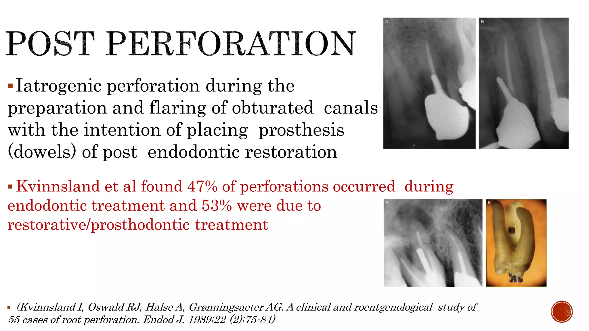 Iatrogenic perforation during the
preparation and flaring of obturated canals
with the intention of placing prosthesis
(dowels) of post endodontic restoration
 Kvinnsland et al found 47% of perforations occurred during
endodontic treatment and 53% were due to
restorative/prosthodontic treatment
 (Kvinnsland I, Oswald RJ, Halse A, Grønningsaeter AG. A clinical and roentgenological study of
55 cases of root perforation. Endod J. 1989;22 (2):75-84)
 