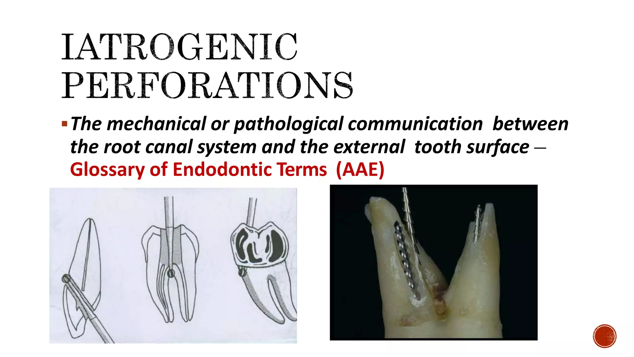 The mechanical or pathological communication between
the root canal system and the external tooth surface –
Glossary of Endodontic Terms (AAE)
 
