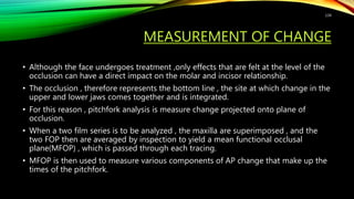 MEASUREMENT OF CHANGE
• Although the face undergoes treatment ,only effects that are felt at the level of the
occlusion can have a direct impact on the molar and incisor relationship.
• The occlusion , therefore represents the bottom line , the site at which change in the
upper and lower jaws comes together and is integrated.
• For this reason , pitchfork analysis is measure change projected onto plane of
occlusion.
• When a two film series is to be analyzed , the maxilla are superimposed , and the
two FOP then are averaged by inspection to yield a mean functional occlusal
plane(MFOP) , which is passed through each tracing.
• MFOP is then used to measure various components of AP change that make up the
times of the pitchfork.
134
 
