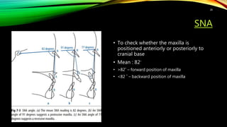SNA
• To check whether the maxilla is
positioned anteriorly or posteriorly to
cranial base
• Mean : 82˚
• >82˚ – forward position of maxilla
• <82 ˚ – backward position of maxilla
28
 